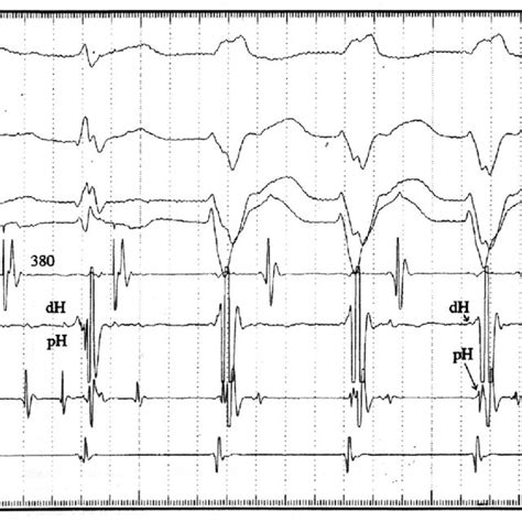 Decremental Property Of The Mahaim Fiber During Rapid Atrial Pacing At Download Scientific