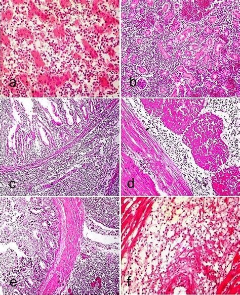 Section Of Tissues From Chickens With Mareks Disease Showing Extensive