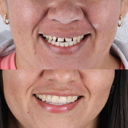 Antes Y Despu S Dise O De Sonrisa Carillas Dentales De Werlin Torres