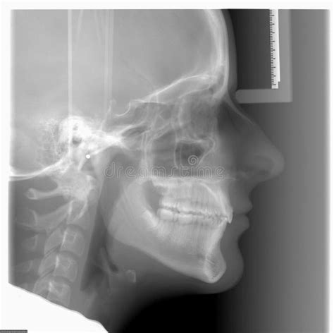 Cephalometric X Ray Used In Dentistry And Orthodontics Stock Photo