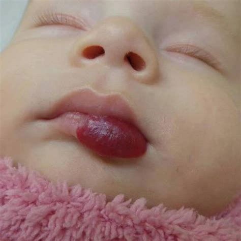 Superficial Hemangioma Of The Central Part Of The Face Periorbital