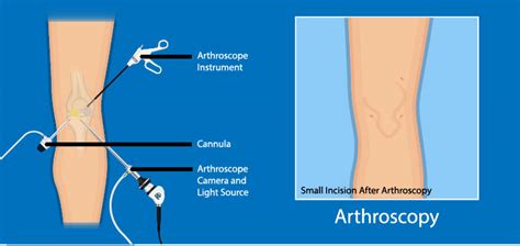 Knee Arthroscopy Melbourne Malvern Werribee MOATI