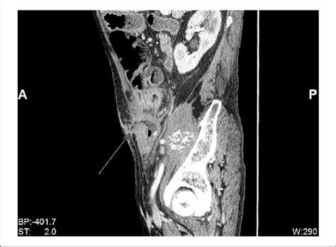 Sagittal Reconstruction Of Ct Abdomen And Pelvis With Oral And Iv Download Scientific Diagram