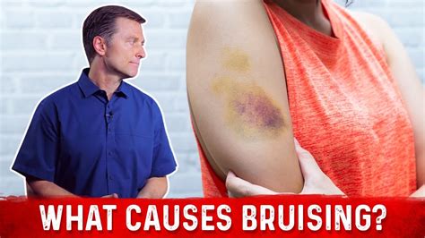 What Causes Bruising Without Trauma Dr Berg Youtube