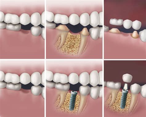 Dental Implant Vs Bridge Options For Missing Teeth Check Out Bvoms