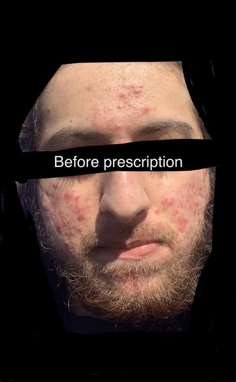 6 Months Of Accutane Before And After Hair Loss Side Effect Tried To