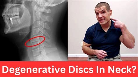 Exercises For Cervical Degenerative Disc Disease