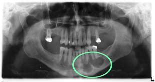 Dental Infection