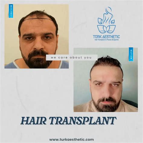 Kosten Einer Haartransplantation In Der T Rkei Turk Aesthetic