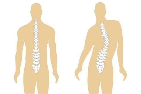 Qu Es La Escoliosis S Ntomas Tipos Y Tratamiento Tua Sa De