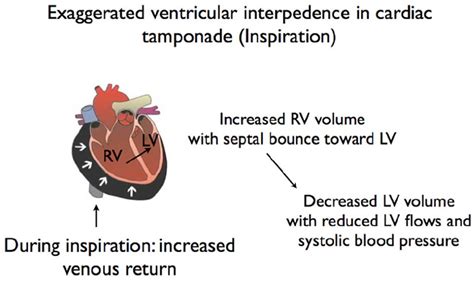 Cardiac Tamponade Symptoms