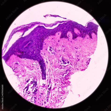 Chest wall cyst(biopsy): Epidermal inclusion cyst, commonly called ...