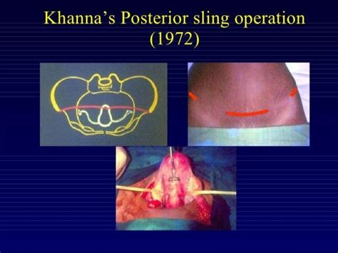 Uterus Preserving Surgeries For Prolapse