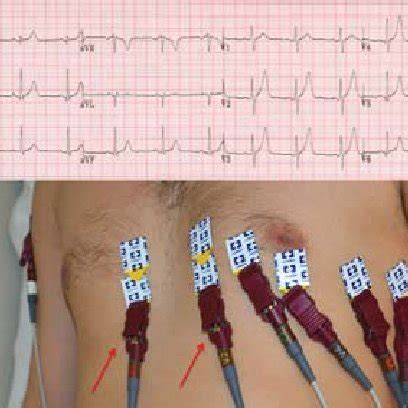 12 Lead ECG Placement Color