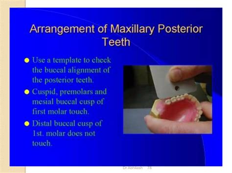 Arrangement of teeth in complete denture | PPTX