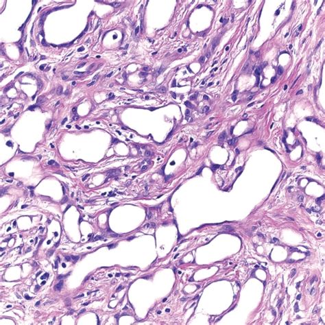 Adenomatoid Tumor Of Testis Pmc