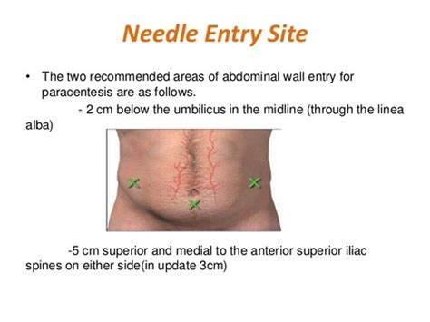 Paracentesis Flashcards | Quizlet