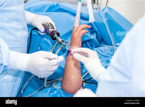 Group Of Orthopedic Surgeons Performing A Wrist Arthroscopy On A Male