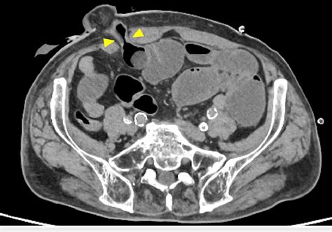 Ct Image Of A Small Bowel Obstruction At The Stoma Site Axial View Download Scientific