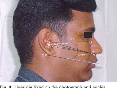 Figure 1 From A Determination Of Occlusal Plane Comparing Different