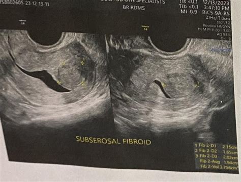 Subserosal Fibroid : r/Fibroids