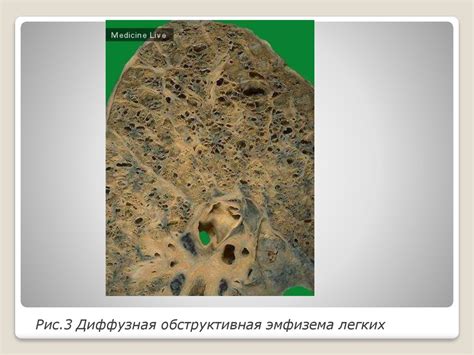 Эмфизема легких - online presentation