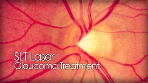 Slt Laser Procedure For Glaucoma