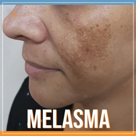 Tipos De Melasma Conhe A Os Principais E Saiba Como Trata Los O