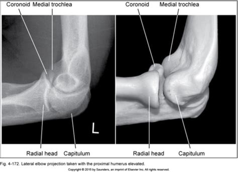 Image Analysis Upper Extremity Flashcards Quizlet