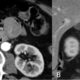 A Axial Computed Tomography Ct Scan Arterial Phase