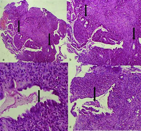 A And B Photomicrograph Of The Colonic Biopsies Demonstrating Widely Download Scientific