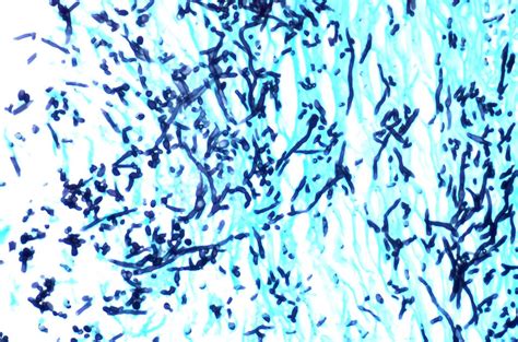 Candidiasis | Silver stain (GMS) showing psuedohyphae and bu… | Flickr