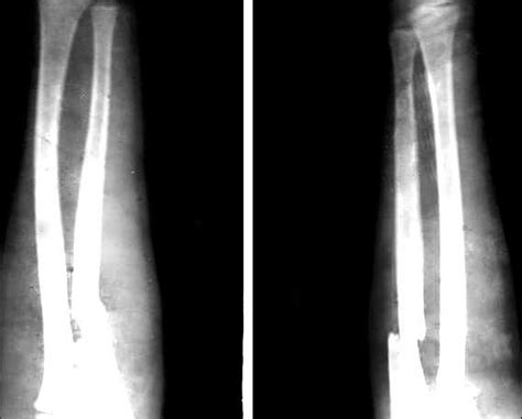 Radiografía Del Antebrazo Total Con Fractura Del Tercio Proximal Del