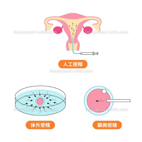 人工授精、体外受精、顕微授精のイラスト 225859756 イメージマート