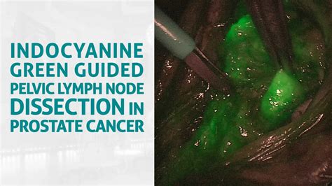 Ais Channel Indocyanine Green Guided Pelvic Lymph Node Dissection In