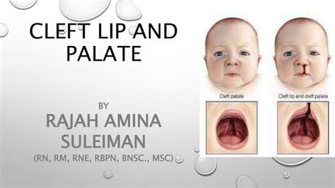 Cleft Lip And Palateppt