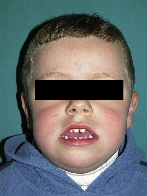 An Idiopathic Case Of Macroglossia Journal Of Plastic Reconstructive