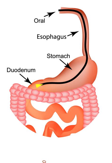 Upper Endoscopyegd Esophagogastroduodenoscopy Usdh