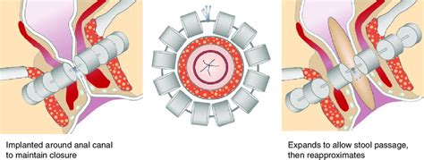4 Magnetic Anal Sphincter Augmentation Device Closed To The Left And