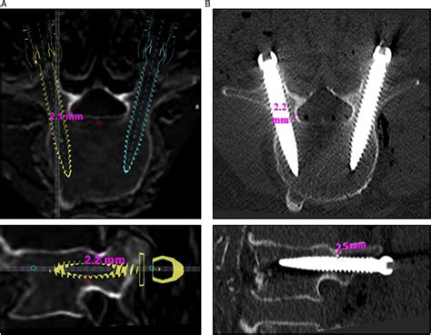 Robot Assisted Lumbar Pedicle Screw Placement Based On 3d Magnetic