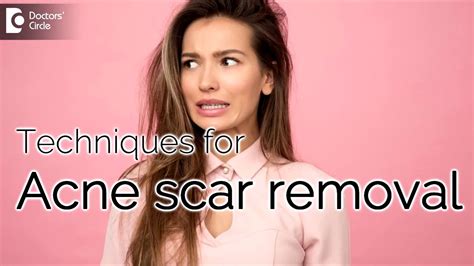 Is It Possible To Remove Acne Scars Permanently Youtube