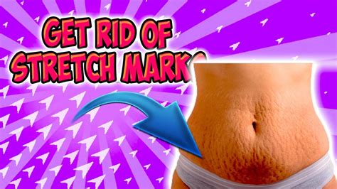 How To Get Rid Of Stretch Marks Naturally Fast Get Rid Of Stretch