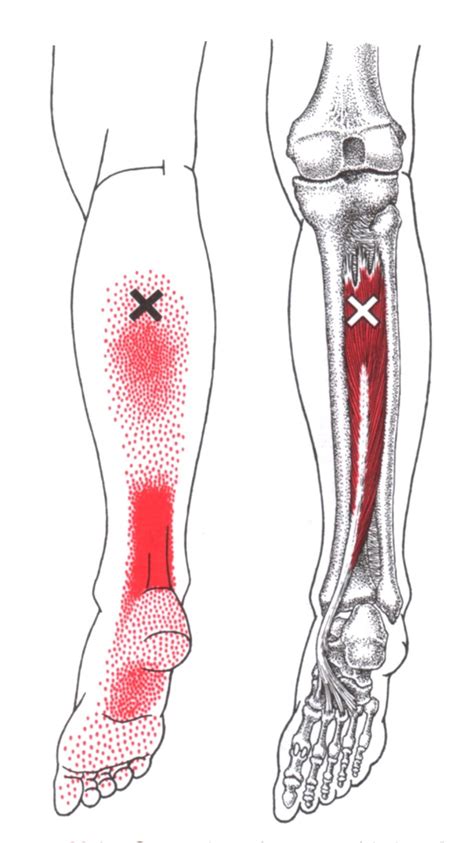 Hinterer Schienbeinmuskel The Trigger Point And Referred Pain Guide