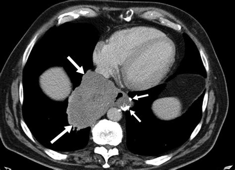 Imaging And Clinicopathologic Features Of Esophageal Gastrointestinal