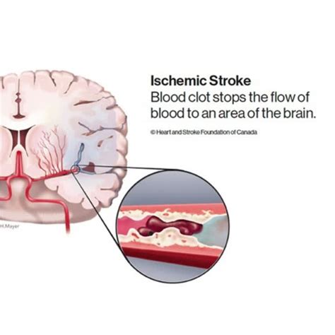 [Video] Heart & Stroke on LinkedIn: A stroke happens when blood stops ...