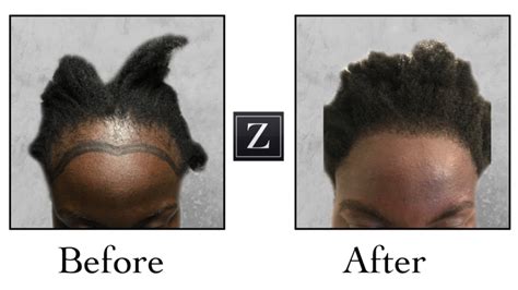 African American Hair Transplant Photos Ziering Medical