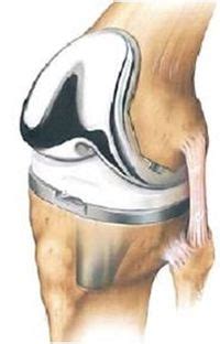 Total Knee Joint Replacement Revision Surgery - Physiopedia