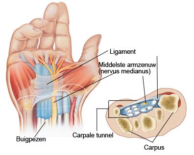 Carpaaltunnel Syndroom Behandelen Chiropractie Ceintuurbaan