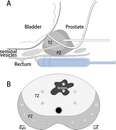 Combined Mri Trus Fusion Targeted And Systematic Biopsy Versus Systematic Biopsy Alone For The