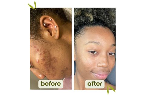 Struggling With Old Acne Scars Lets Talk Donata Skinfood